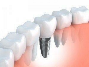 dental implants in spring